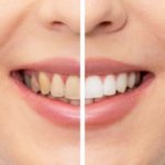 brightening-smiles-exploring-teeth-whiteners