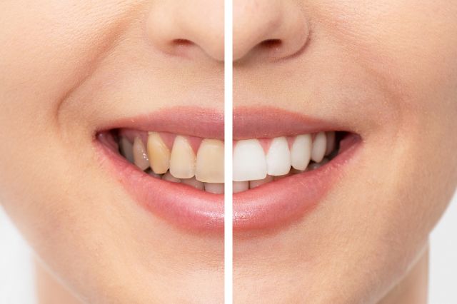 brightening-smiles-exploring-teeth-whiteners